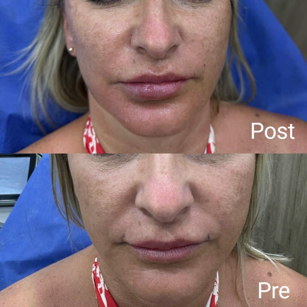 فيلر الخدود قبل وبعد